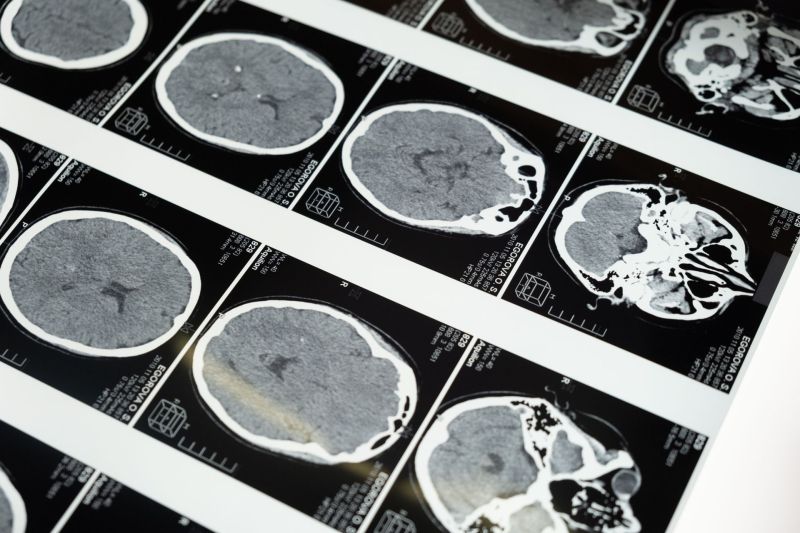 Zašto napredna magnetna rezonanca još nije standard kod tumora mozga