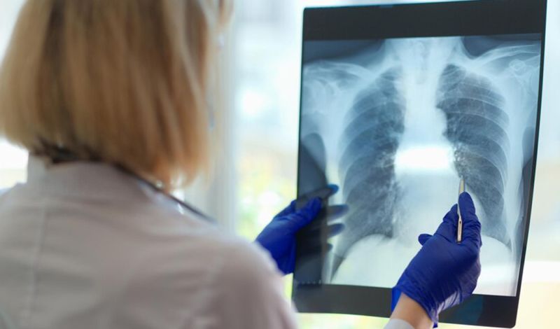 Rendgen grudnog koša (RTG) 