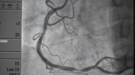 Razumevanje stenoze plućne arterije: uzroci, simptomi i tretmani